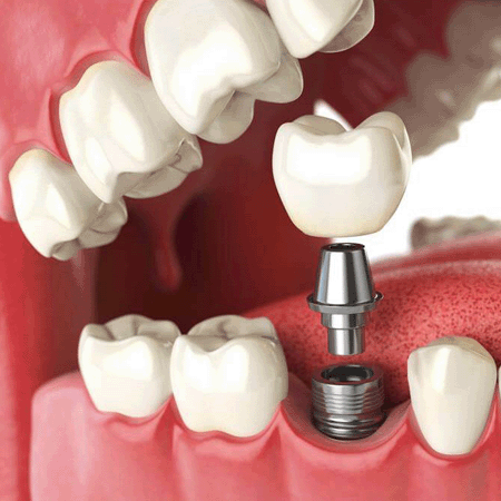 implantologia-dentale
